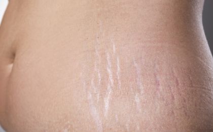 Jak się pozbyć wiotkiej skóry na brzuchu po ciąży?