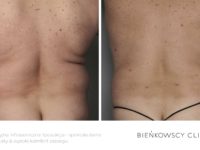 Zdjęcia przed i po zabiegu odsysania tkanki tłuszczowej liposukcji w Bieńkowscy Clinic