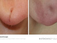 Zdjęcia przed i po zabiegu dermatochirurgicznym w Bienkowscy Clinic Bydgoszcz i Częstochowa