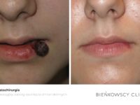 Zdjęcia przed i po zabiegu dermatochirurgicznym w Bienkowscy Clinic Bydgoszcz i Częstochowa