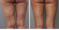 Zdjęcia przed i po zabiegu redukcji usuwania tkanki tłuszczowej i cellulitu HIFU HIFU w Bienkowscy Clinic