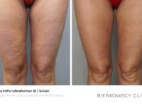 Zdjęcia przed i po zabiegu redukcji usuwania tkanki tłuszczowej i cellulitu Scizer HIFU w Bienkowscy Clinic Bydgoszcz i Częstochowa