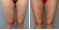 Zdjęcia przed i po zabiegu redukcji usuwania tkanki tłuszczowej i cellulitu HIFU HIFU