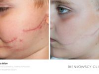 Zdjęcia przed i po zabiegu usuwania blizn w Bieńkowscy Clinic Bydgoszcz i Częstochowa
